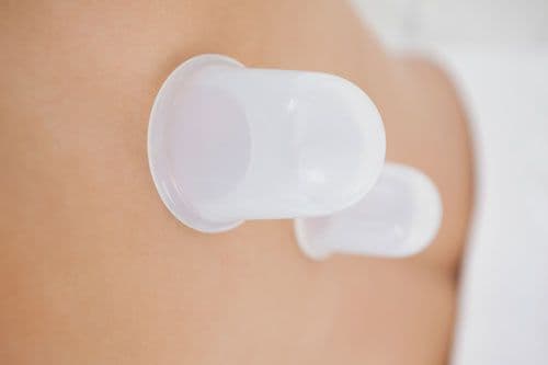 Cupping Therapy